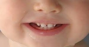پیشگیری ازپوسیدگی دندان های کودکان
