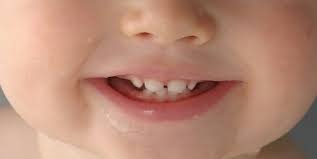 پیشگیری ازپوسیدگی دندان های کودکان