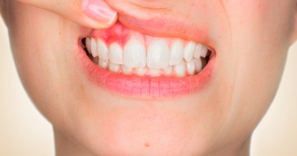 جلوگیری از ایجاد حساسیت دندانی
